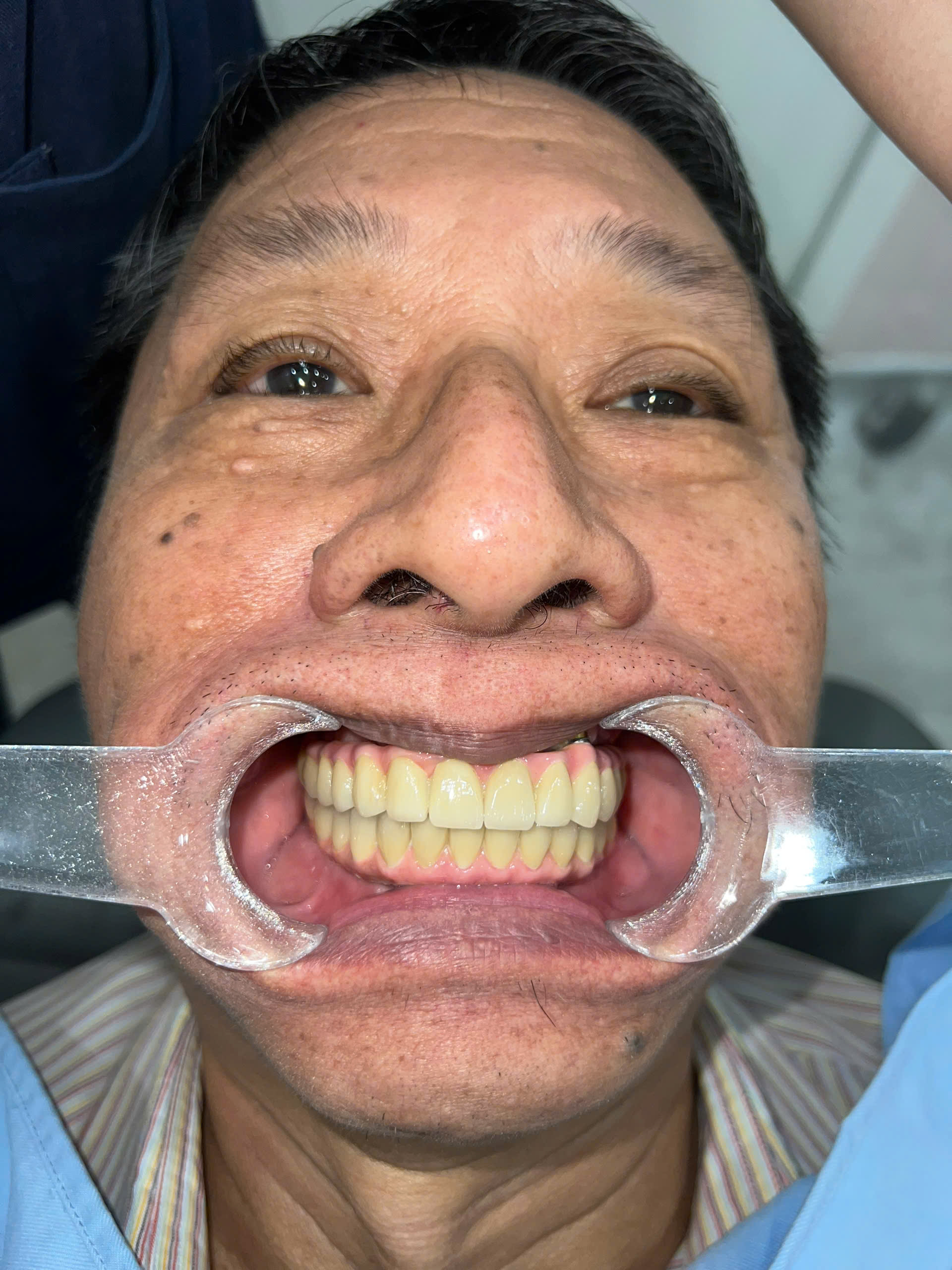 After treatment