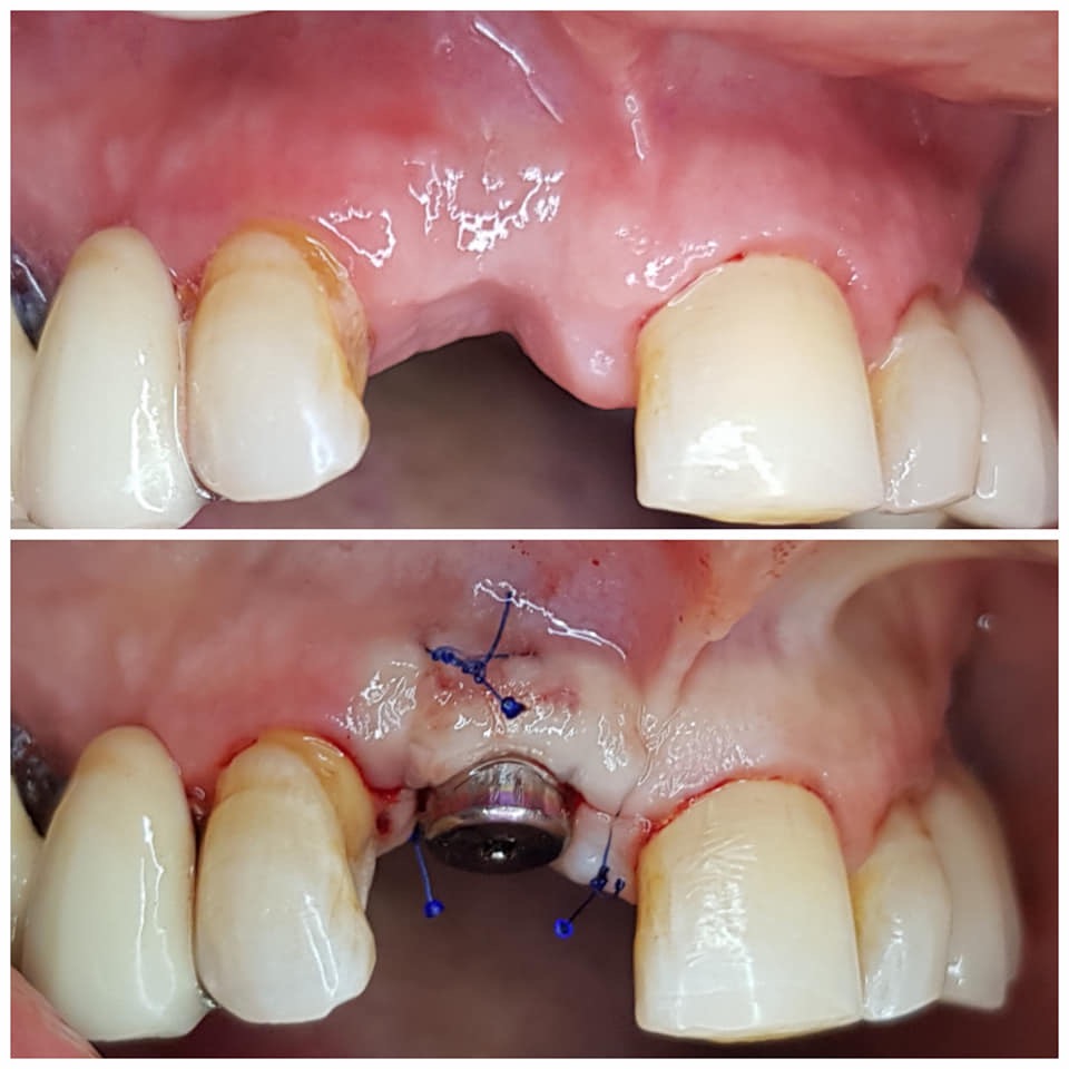 Implant case