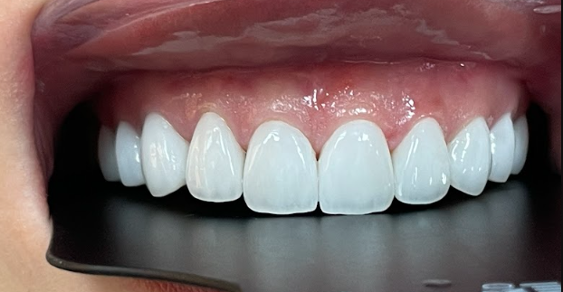 Veneer case