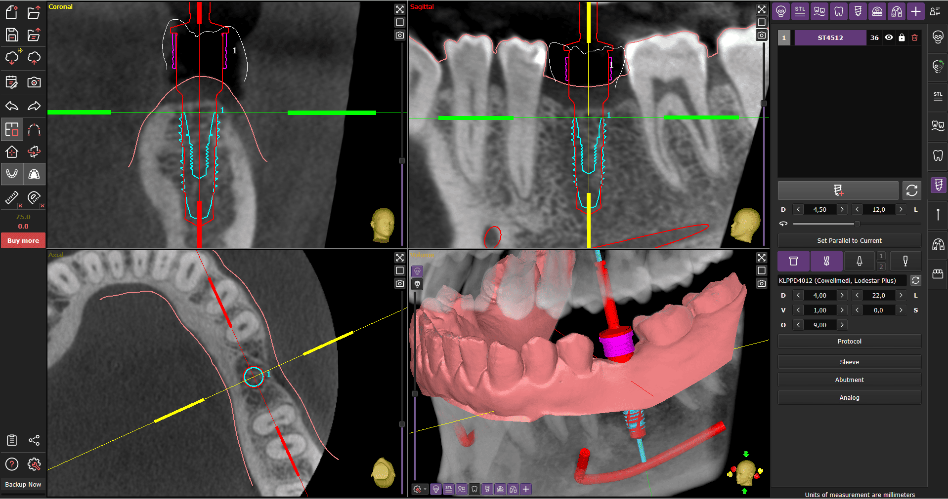 ImplaStation implant planning