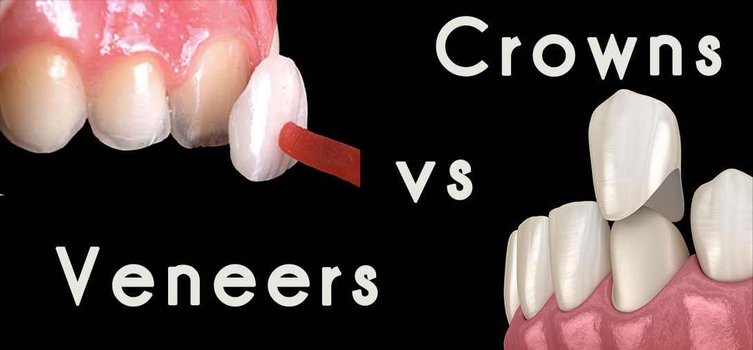 Crowns vs veneers